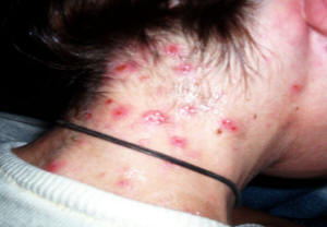 image source: http://morgellonsexposed.com/YourPhotos.htm