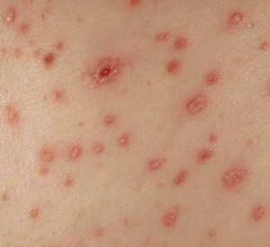 morgellons-skin-rash-300x275.jpg